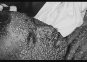 Każda epidemia w ZSRR zwalczana była przy użyciu wszystkich dostępnych sposobów, jeżeli zachodziła taka potrzeba nie przebierano w środkach.