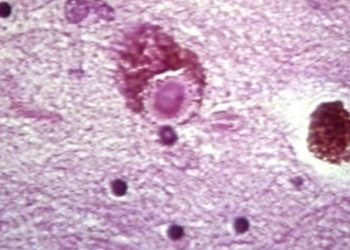 Jeżeli te symptomy się objawią, śmierć jest pewna. Dlaczego milczy się na ten temat?