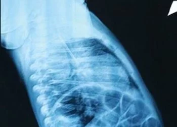 Przerażające odkrycie w ciele dziecka. Gdy lekarze zobaczyli te zdjęcia, zamarli. Nigdy czegoś takiego nie widzieli