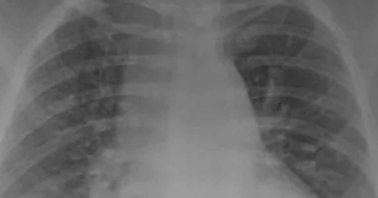 Przerażające zdjęcia RTG trafiły do sieci. Oto cała prawda o działaniu szczepionek