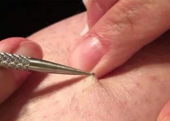 Noga swędziała go w jednym miejscu od ponad 3 lat. Nagle odkrył tam szew i zaczął go ciągnąć