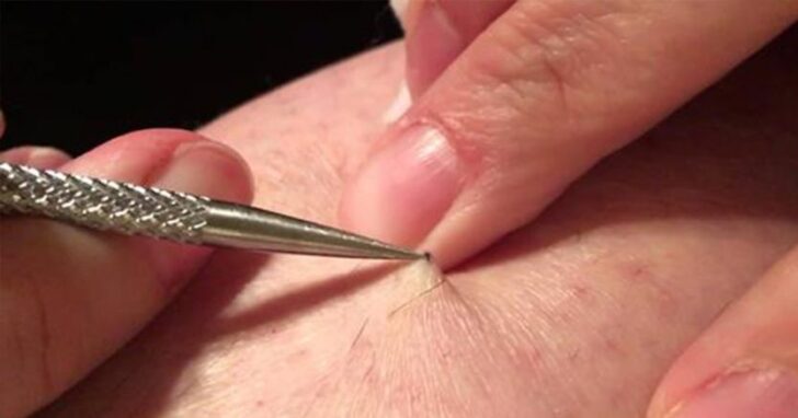 Noga swędziała go w jednym miejscu od ponad 3 lat. Nagle odkrył tam szew i zaczął go ciągnąć